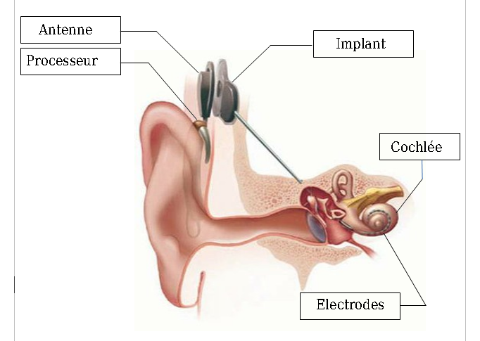 schema-implant-cochleaire.png